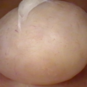 snear polypectomy
